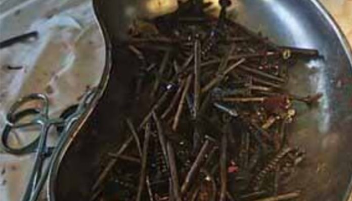 Doctors in Lithuania find kilo of nails and screws in man’s stomach