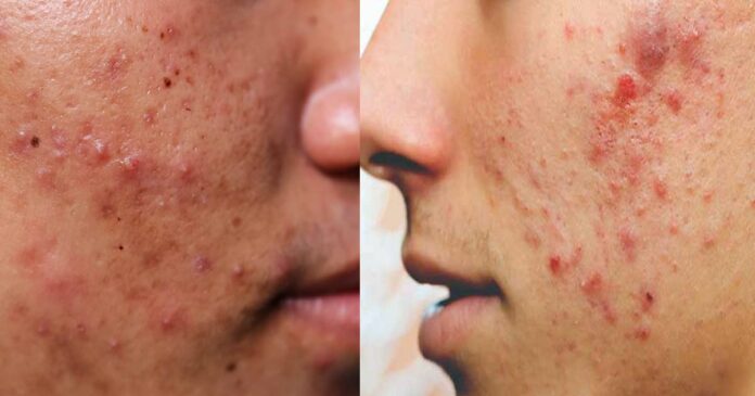 Are acne scars ruining your confidence? So try this home remedy...