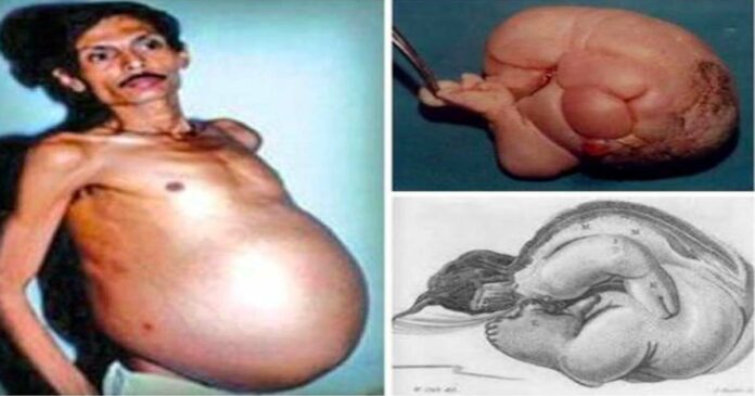 'Fetus in Fetu'! Nagpur man carried baby in his stomach for 36 years